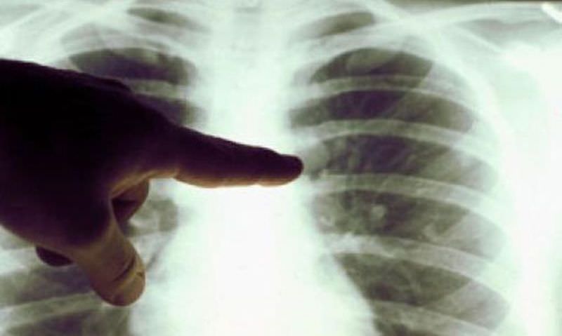 video - cazurile de tuberculoză la sibiu. stăm bine în statistici