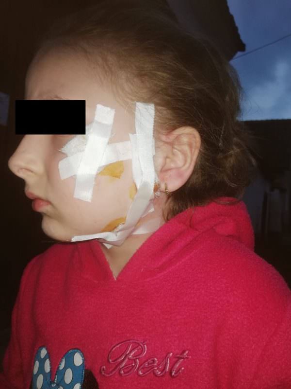 foto fetiță mușcată de față de un câine - familia se revoltă: „copila mea era să moară!”