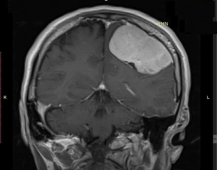 reușită la spitalul județean sibiu - medicii au extirpat o tumoare cerebrală gigantă