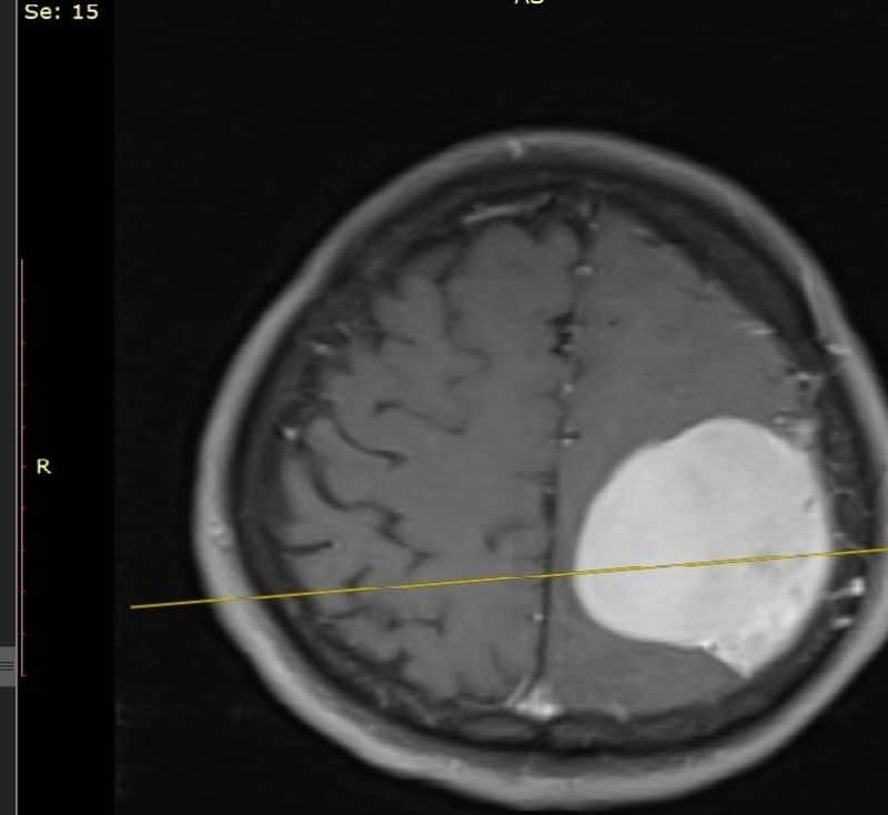 reușită la spitalul județean sibiu - medicii au extirpat o tumoare cerebrală gigantă