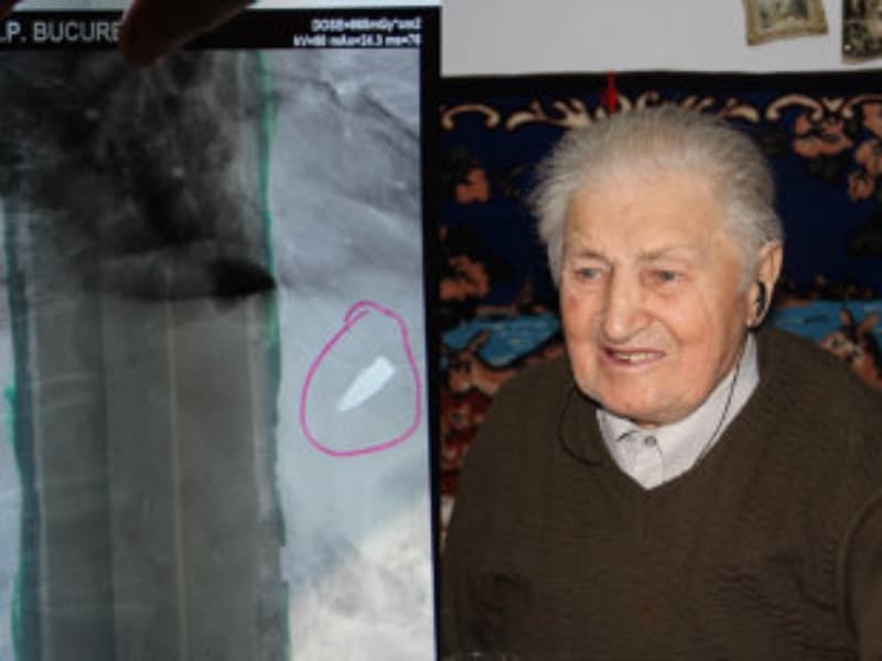 povestea românului care trăieşte de 80 de ani cu un glonţ lângă inimă