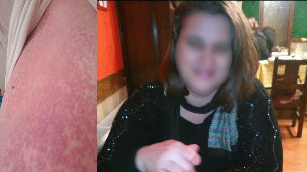 acuzații de malpraxis la spitalul județean sibiu - o femeie trece prin chinuri groaznice: „am toată pielea carne vie”