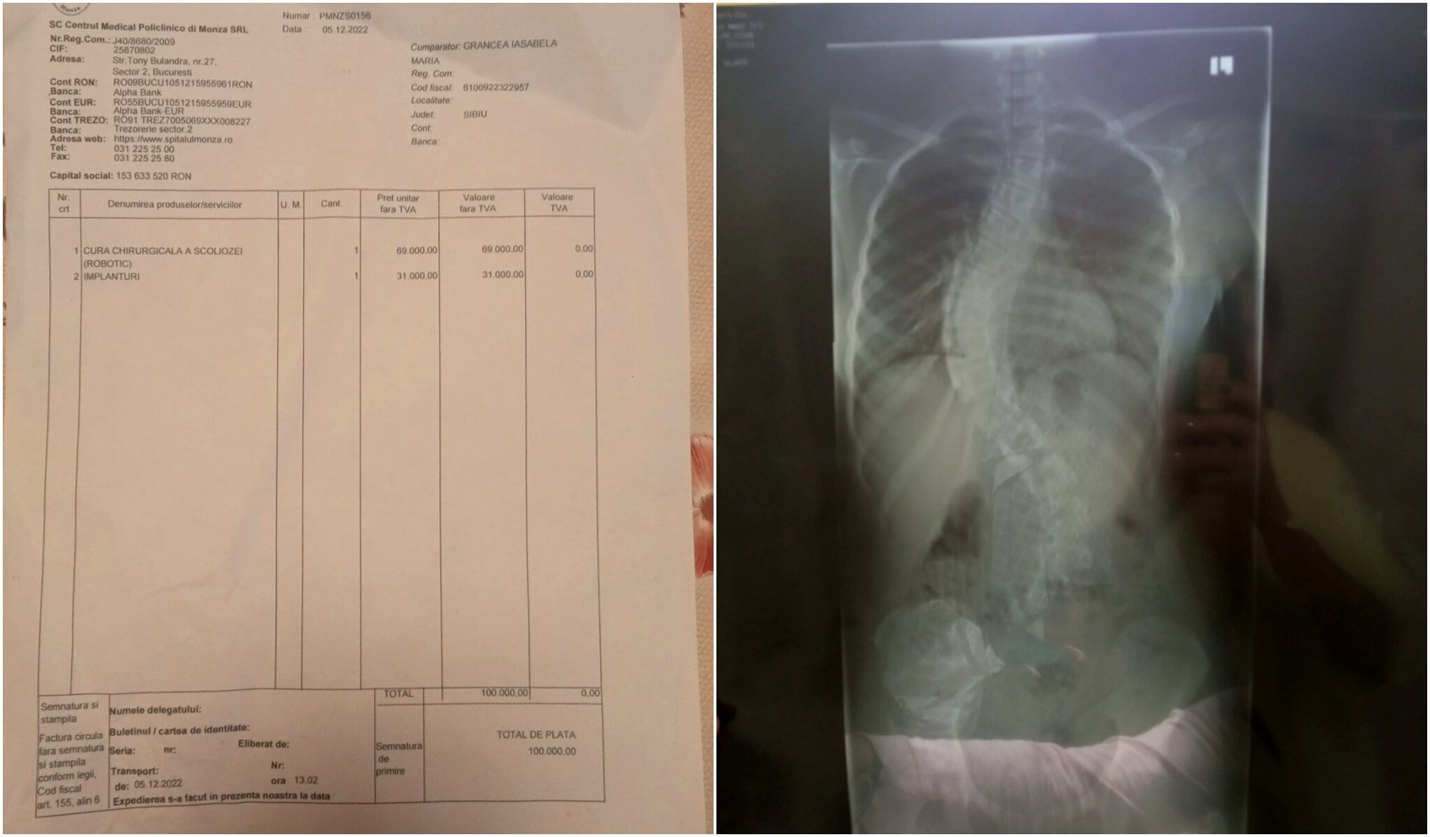 o fetiță din sibiu are nevoie de 100.000 de lei pentru o operație la coloană - isabela suferă de scolioză idiopatică