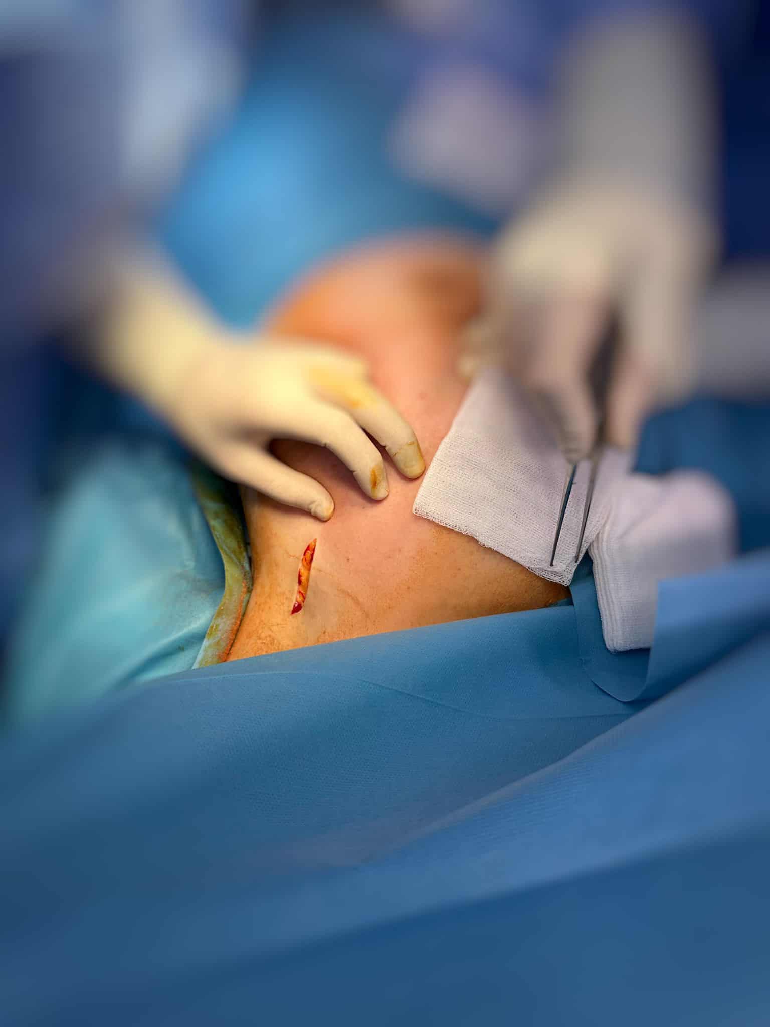 intervenții minim invazive asupra cancerului de sân cu aparatură ultramodernă la spitalul județean sibiu