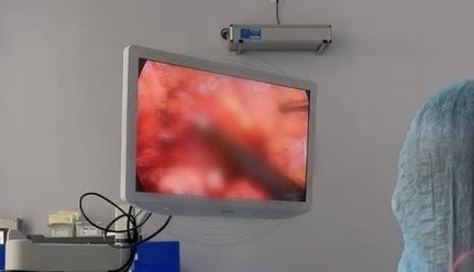 intervenție în premieră la spitalul județean din sibiu, la un pacient bolnat de cancer rectal
