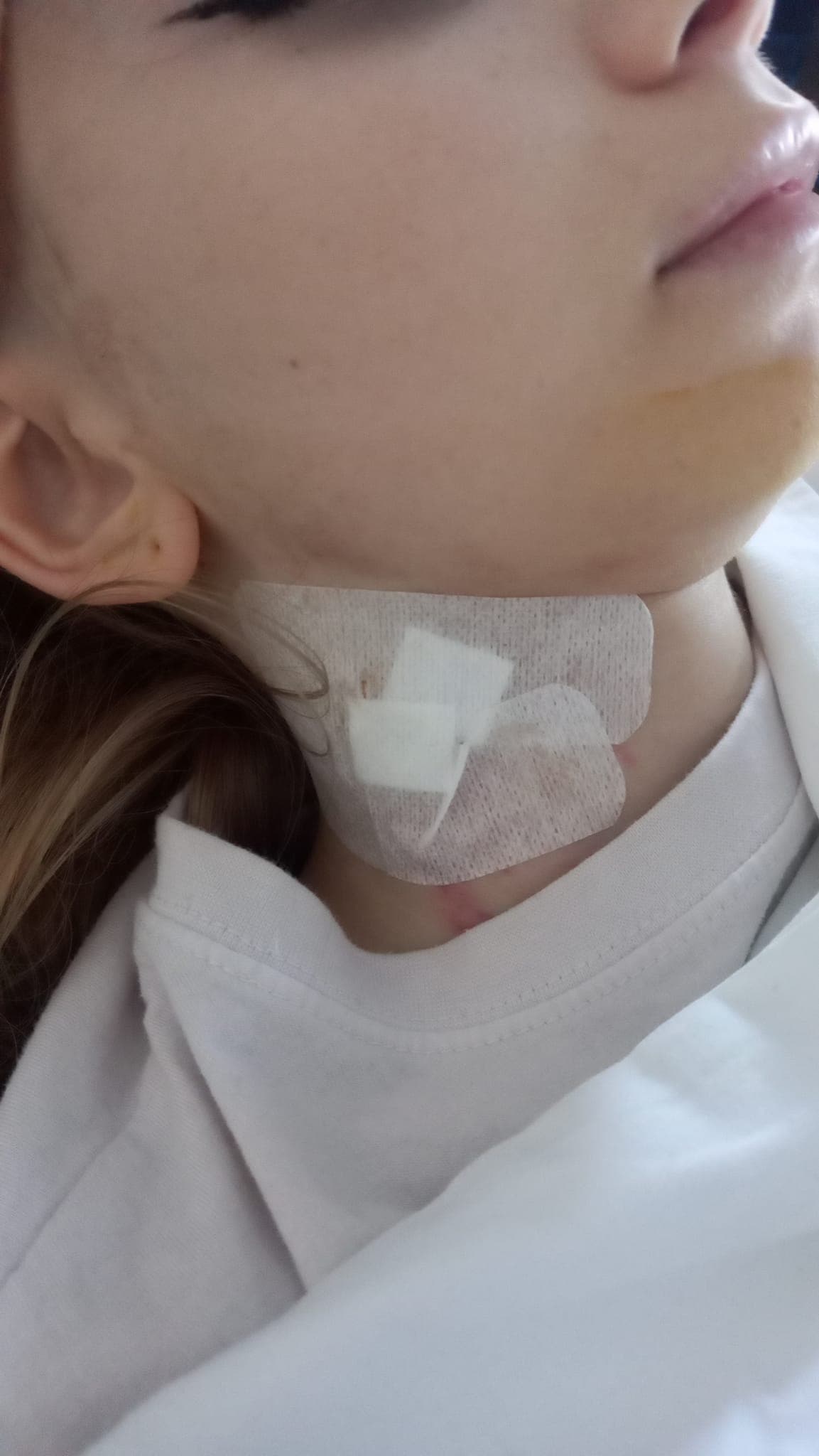 O adolescentă din Cisnădie luptă împotriva metastazei pulmonare. Georgiana are nevoie de reconstrucţia stomacului